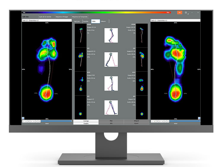 Analyse posturale par podométrie Analyse posturale par podométrie